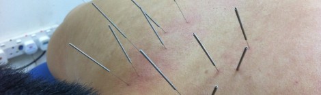 Acupuncture & Bone-Setting – Pain Relief !