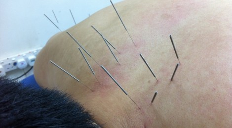 Acupuncture & Bone-Setting – Pain Relief !